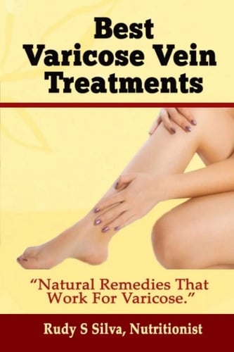 Portada de Varices Best Varicose Vein Treatments: Natural Remedies 