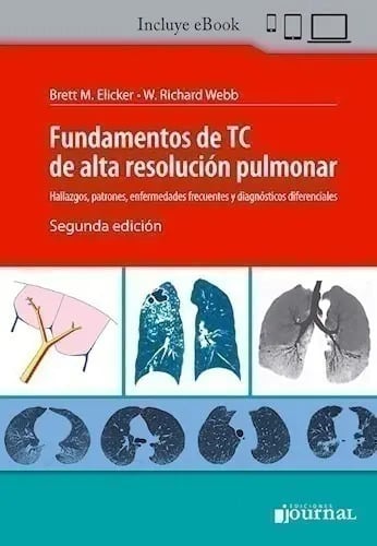 Fundamentos De Tc De Alta Resolución Pulmonar