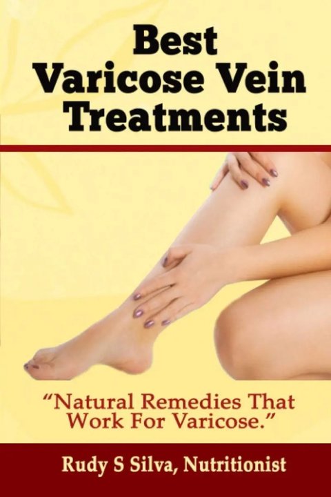 Varices Best Varicose Vein Treatments: Natural Remedies