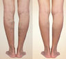Varices Best Varicose Vein Treatments: Natural Remedies — imagen 3